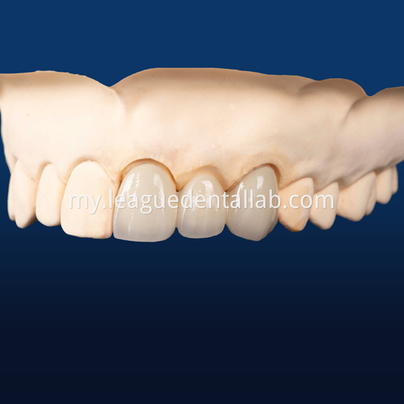 PFZ,Porcelain Fused to Zirconia,Zirconia Layered, Zirconia Veneered